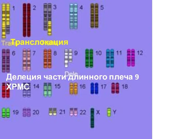 Делеция части длинного плеча 9 ХРМС Транслокация