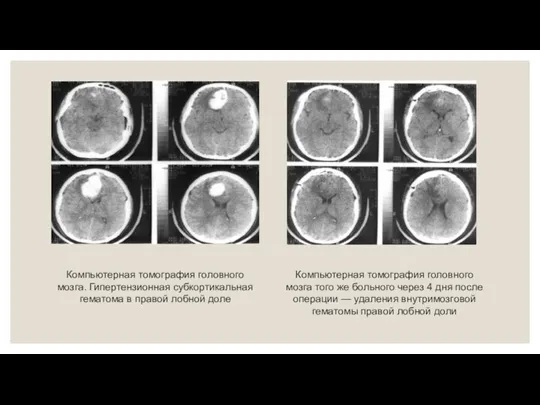 Компьютерная томография головного мозга. Гипертензионная субкортикальная гематома в правой лобной доле Компьютерная томография