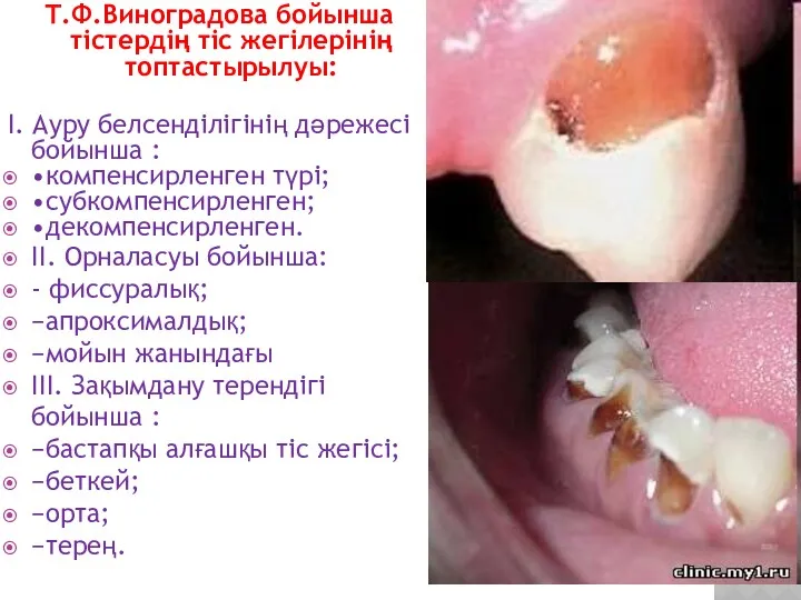 Т.Ф.Виноградова бойынша тістердің тіс жегілерінің топтастырылуы: I. Ауру белсенділігінің дәрежесі бойынша : •компенсирленген