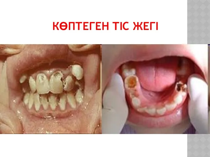 КӨПТЕГЕН ТІС ЖЕГІ