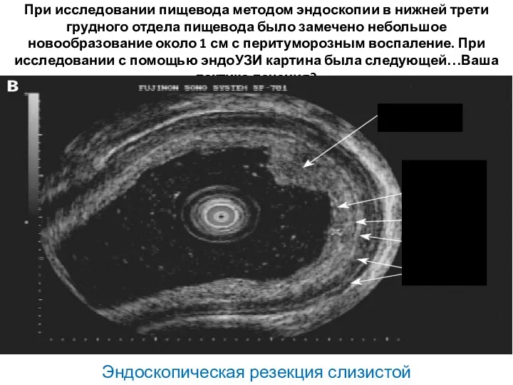 При исследовании пищевода методом эндоскопии в нижней трети грудного отдела