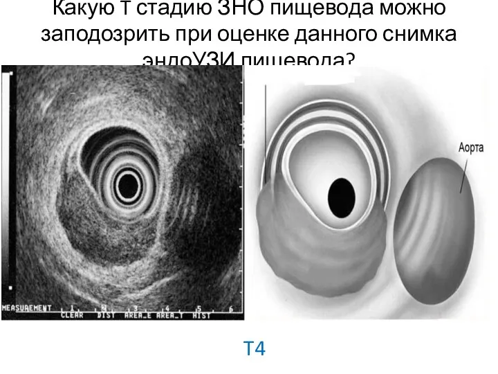 Какую T стадию ЗНО пищевода можно заподозрить при оценке данного снимка эндоУЗИ пищевода? T4