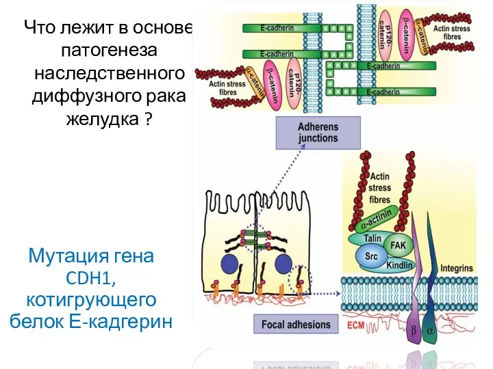 Что лежит в основе патогенеза наследственного диффузного рака желудка ? Мутация гена CDH1, котигрующего белок Е-кадгерин