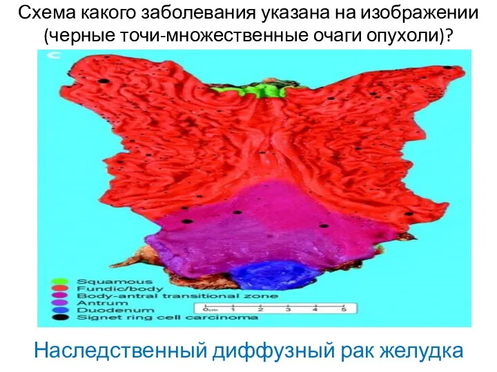 Схема какого заболевания указана на изображении (черные точи-множественные очаги опухоли)? Наследственный диффузный рак желудка