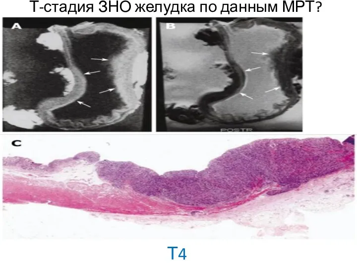 Т-стадия ЗНО желудка по данным МРТ? Т4