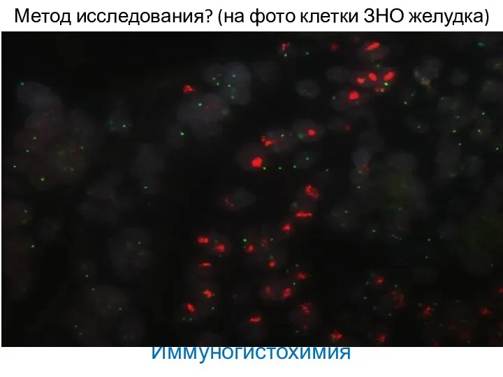 Метод исследования? (на фото клетки ЗНО желудка) Иммуногистохимия