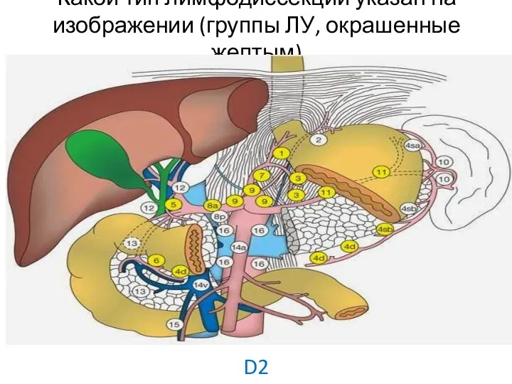 Какой тип лимфодиссекции указан на изображении (группы ЛУ, окрашенные желтым) D2