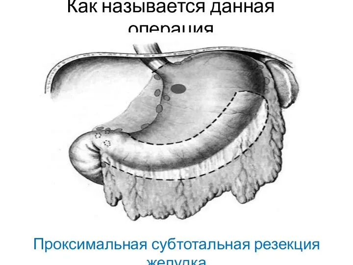 Как называется данная операция Проксимальная субтотальная резекция желудка