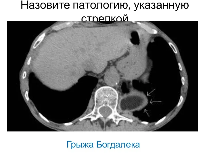 Назовите патологию, указанную стрелкой Грыжа Богдалека
