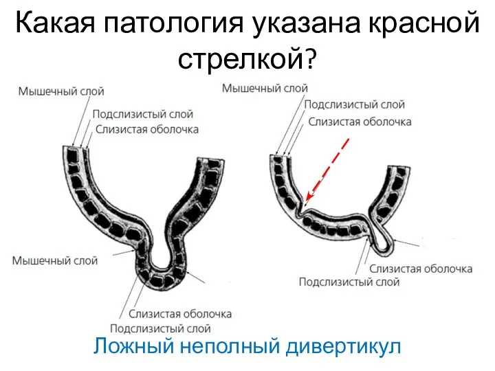 Какая патология указана красной стрелкой? Ложный неполный дивертикул