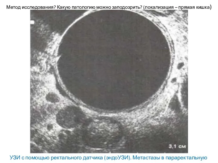 Метод исследования? Какую патологию можно заподозрить? (локализация – прямая кишка)