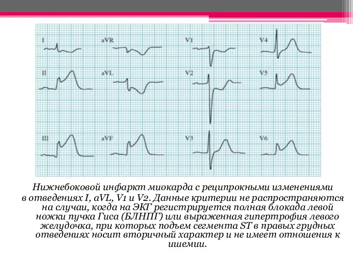 Нижнебоковой инфаркт миокарда с реципрокными изменениями в отведениях I, aVL,