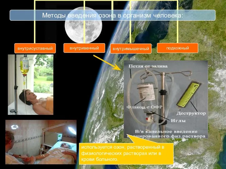 используется озон, растворенный в физиологических растворах или в крови больного.
