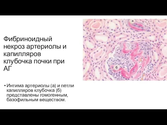 Фибриноидный некроз артериолы и капилляров клубочка почки при АГ Интима