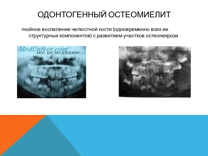 ОДОНТОГЕННЫЙ ОСТЕОМИЕЛИТ гнойное воспаление челюстной кости (одновременно всех ее структурных компонентов) с развитием участков остеонекроза