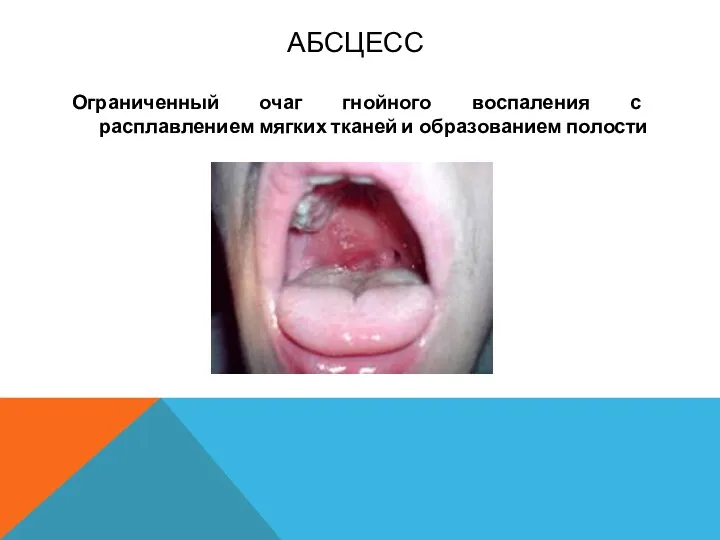 АБСЦЕСС Ограниченный очаг гнойного воспаления с расплавлением мягких тканей и образованием полости