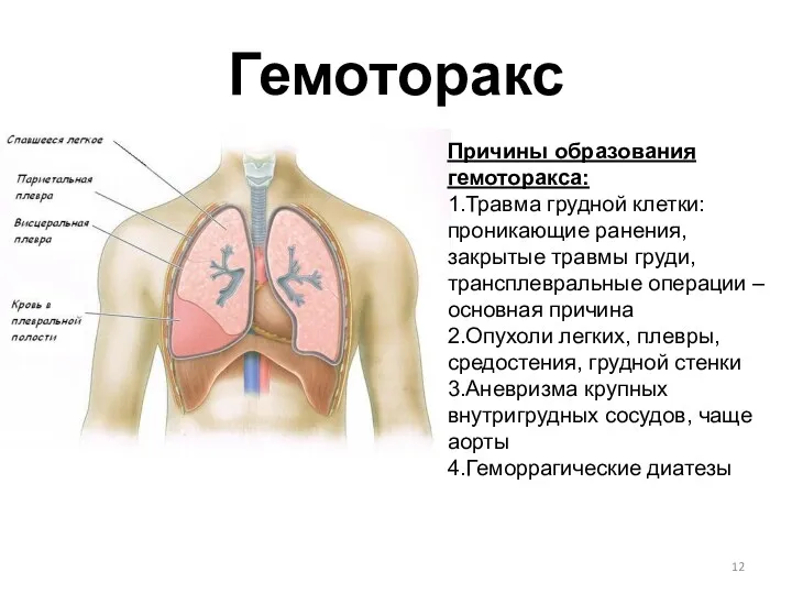 Гемоторакс Причины образования гемоторакса: 1.Травма грудной клетки: проникающие ранения, закрытые