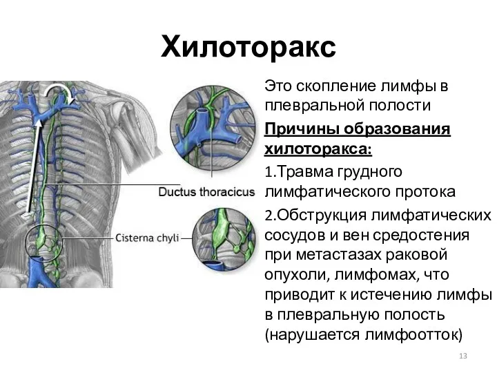 Хилоторакс Это скопление лимфы в плевральной полости Причины образования хилоторакса: