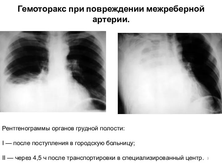 Гемоторакс при повреждении межреберной артерии. Рентгенограммы органов грудной полости: I