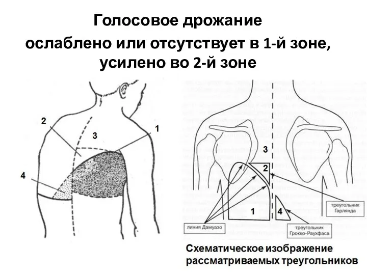 Голосовое дрожание ослаблено или отсутствует в 1-й зоне, усилено во 2-й зоне