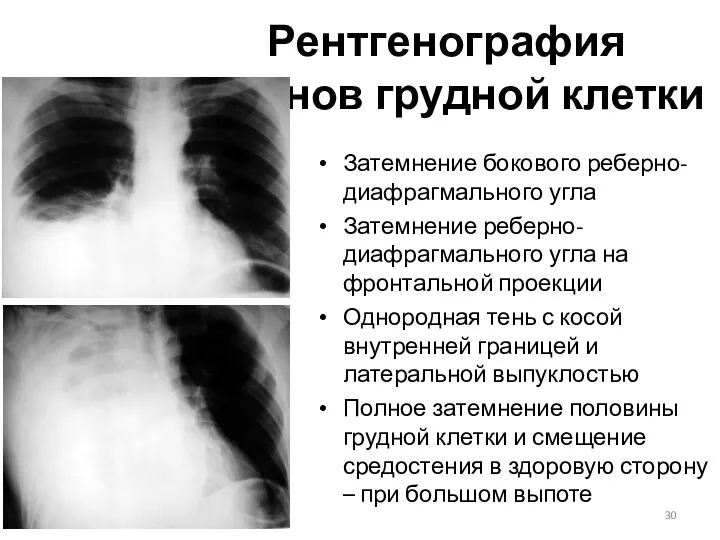 Рентгенография органов грудной клетки Затемнение бокового реберно-диафрагмального угла Затемнение реберно-диафрагмального