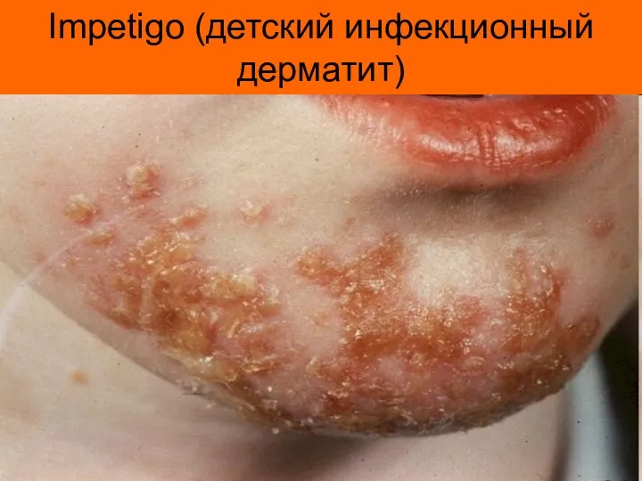 Impetigo (детский инфекционный дерматит)