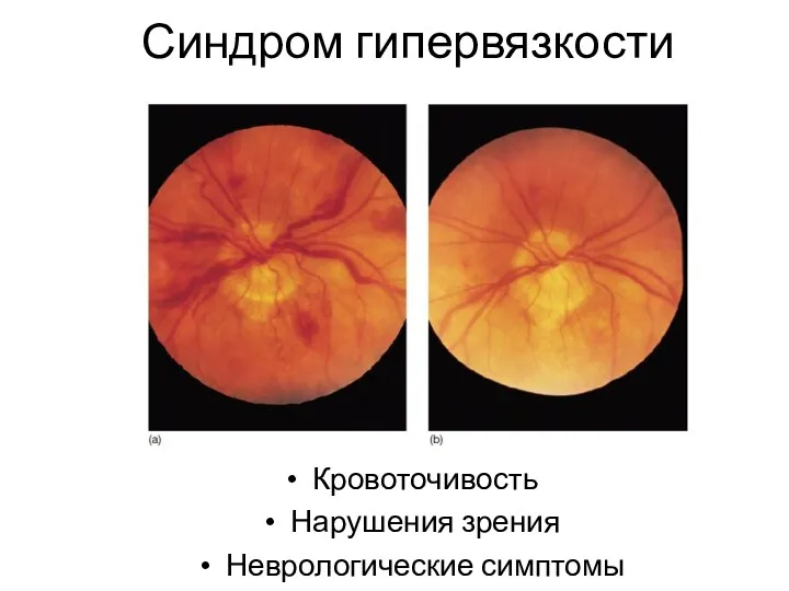 Синдром гипервязкости Кровоточивость Нарушения зрения Неврологические симптомы