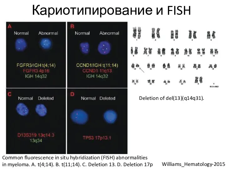Кариотипирование и FISH Deletion of del(13)(q14q31). Common fluorescence in situ