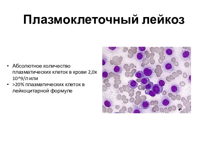 Плазмоклеточный лейкоз Абсолютное количество плазматических клеток в крови 2,0х 10^9/л
