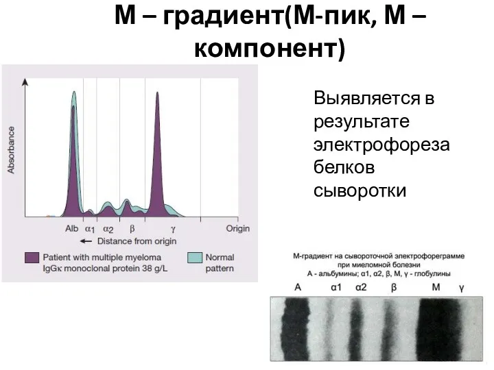 М – градиент(М-пик, М – компонент) Выявляется в результате электрофореза белков сыворотки