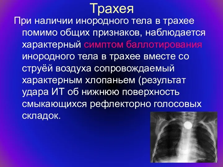 Трахея При наличии инородного тела в трахее помимо общих признаков, наблюдается характерный симптом