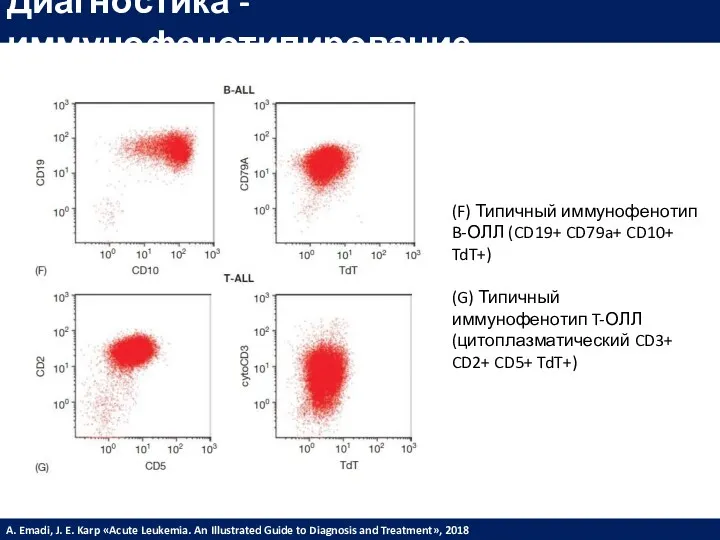 Диагностика - иммунофенотипирование (F) Типичный иммунофенотип B-ОЛЛ (CD19+ CD79a+ CD10+