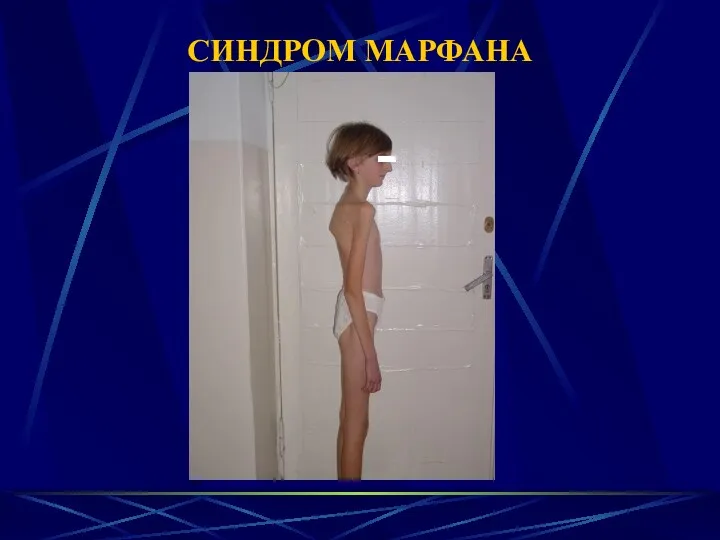 СИНДРОМ МАРФАНА