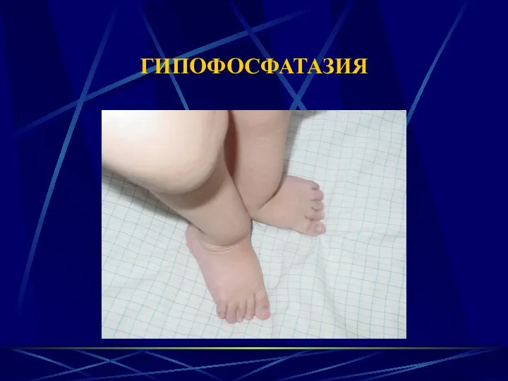 ГИПОФОСФАТАЗИЯ