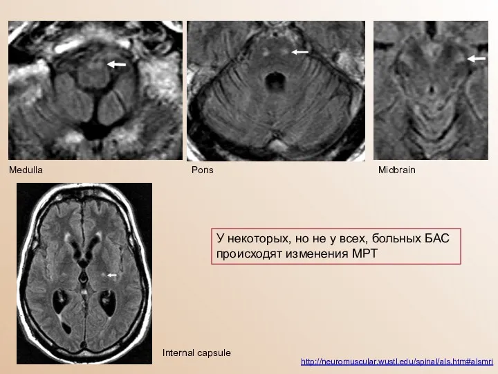 http://neuromuscular.wustl.edu/spinal/als.htm#alsmri У некоторых, но не у всех, больных БАС происходят