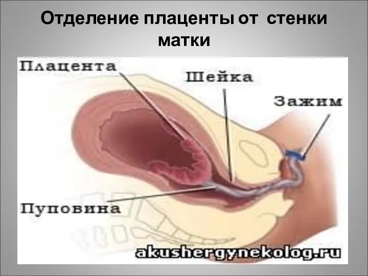 Отделение плаценты от стенки матки