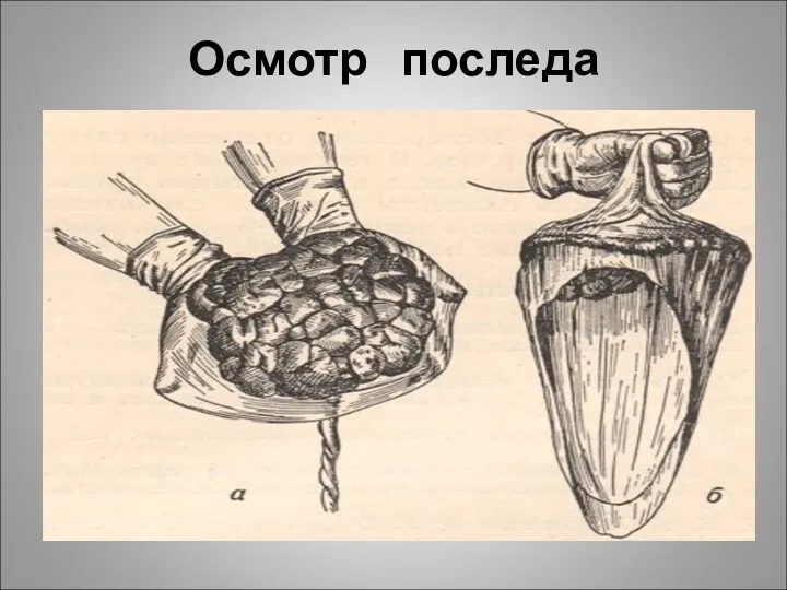 Осмотр последа