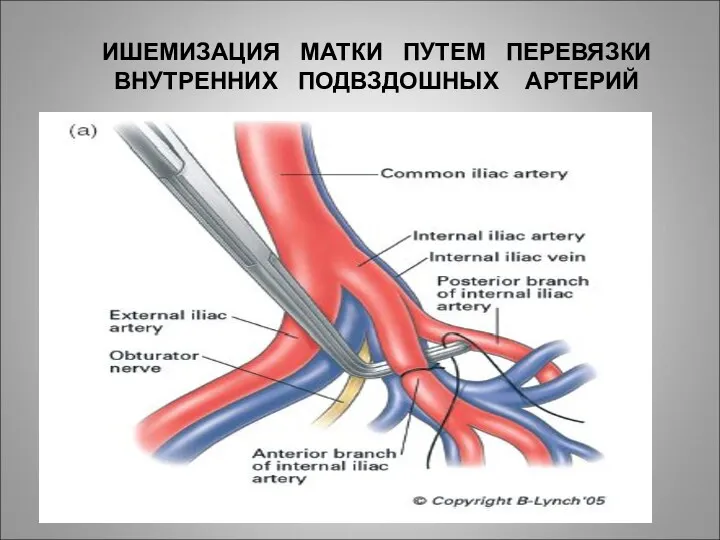 ИШЕМИЗАЦИЯ МАТКИ ПУТЕМ ПЕРЕВЯЗКИ ВНУТРЕННИХ ПОДВЗДОШНЫХ АРТЕРИЙ