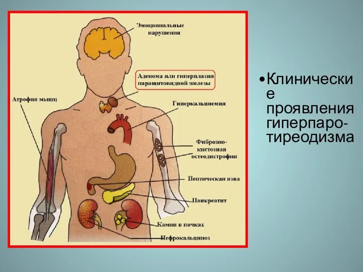 Клинические проявления гиперпаро-тиреодизма