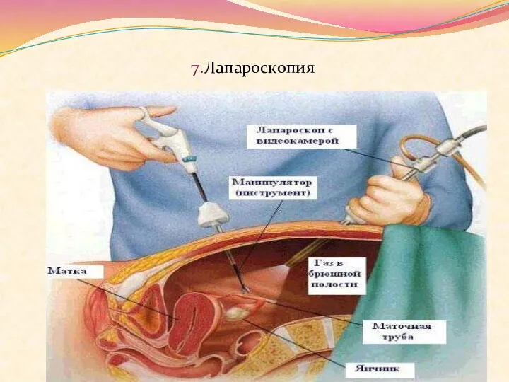 7.Лапароскопия