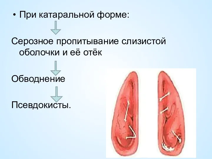 При катаральной форме: Серозное пропитывание слизистой оболочки и её отёк Обводнение Псевдокисты.