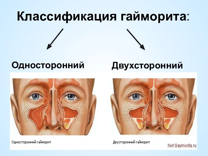 Классификация гайморита: Односторонний Двухсторонний