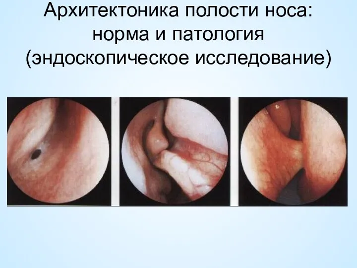 Архитектоника полости носа:норма и патология (эндоскопическое исследование)