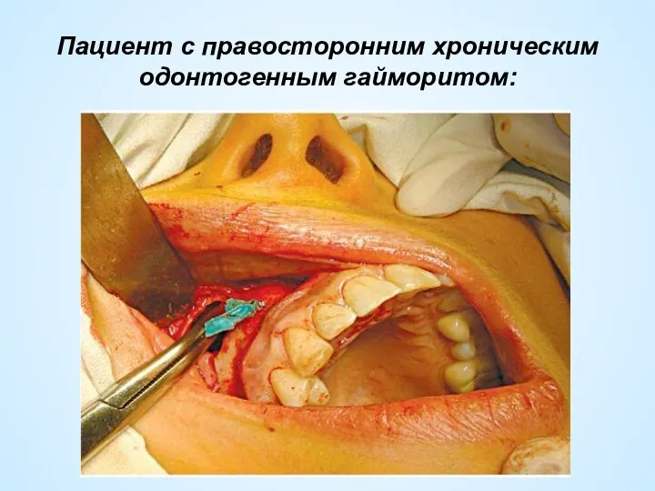 Пациент с правосторонним хроническим одонтогенным гайморитом: