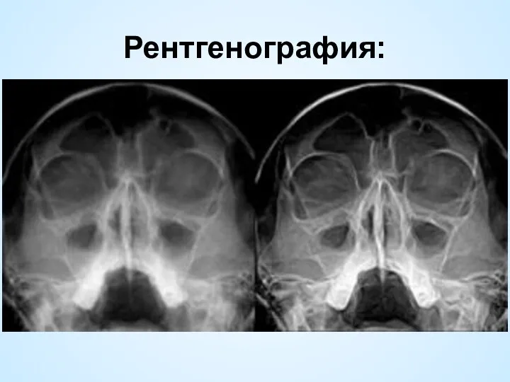 Рентгенография: