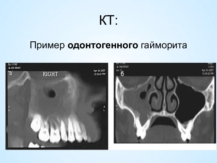 КТ: Пример одонтогенного гайморита