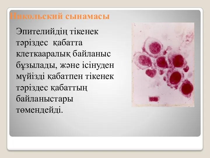 Никольский сынамасы Эпителийдің тікенек тәріздес қабатта клеткааралық байланыс бұзылады, және ісінуден мүйізді қабатпен