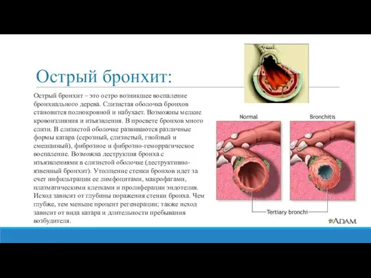 Острый бронхит: Острый бронхит – это остро возникшее воспаление бронхиального