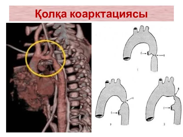 Қолқа коарктациясы