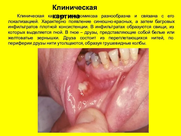 Клиническая картина актиномикоза разнообразна и связана с его локализацией. Характерно